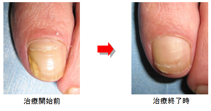 爪 白癬 菌 糖尿病は爪白癬を引き起こす！最悪の場合、足が壊死します