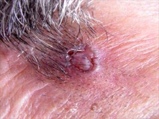 皮膚の悪性腫瘍 皮膚がん 品川区 あおよこ皮膚科クリニック