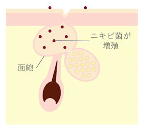 ニキビ ない しこり 潰れ